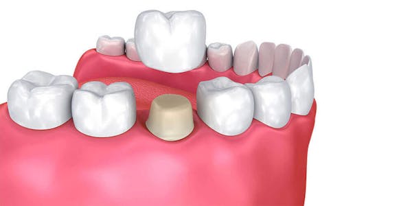 Dental Crowns Whitby