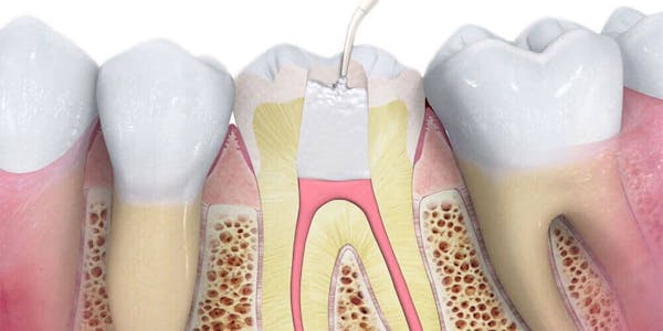 Root Canal Treatment Whitby